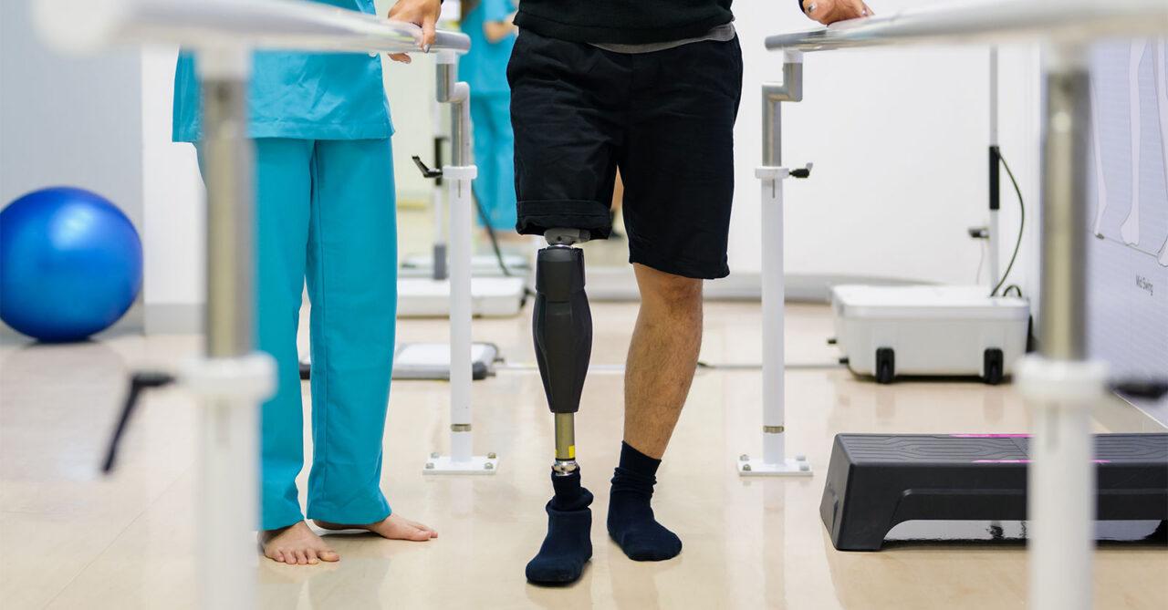 Amputation Negligence Claims in South Africa